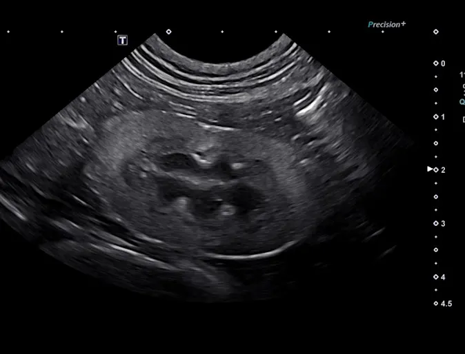 Kidney Pumpkin Kidney Pumpkin