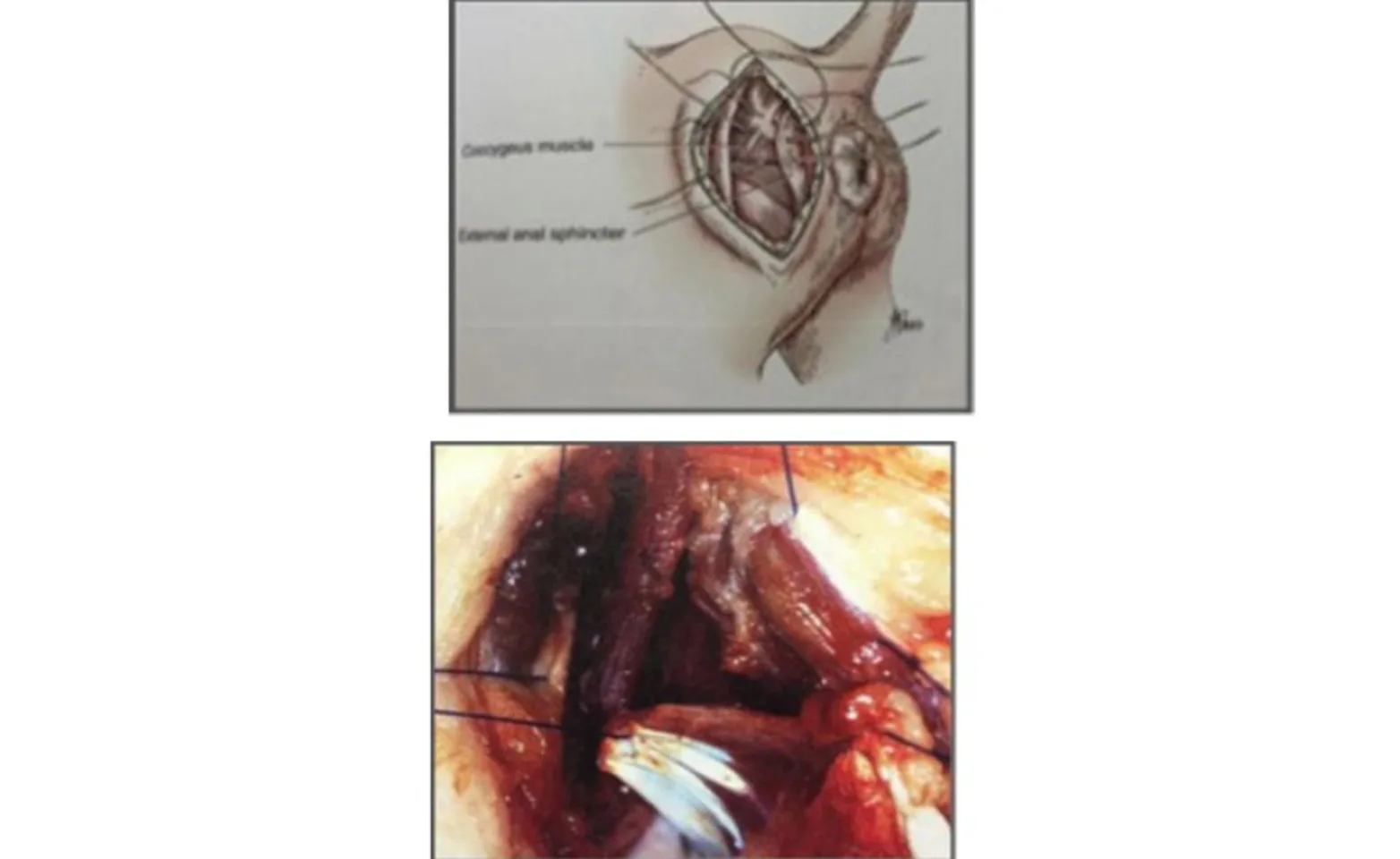 Intraoperative picture of internal obturator muscle transposition. Intraoperative picture of internal obturator muscle transposition.