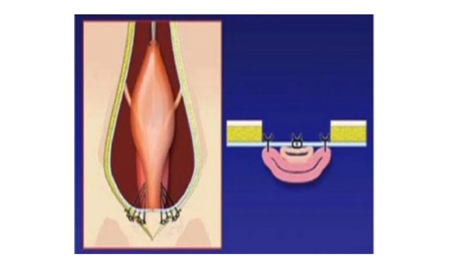 First process of cystourethropexy, which involves pulling the bladder and urethra forward into the abdomen and suturing the urethra to the abdominal wall. First process of cystourethropexy, which involves pulling the bladder and urethra forward into the abdomen and suturing the urethra to the abdominal wall.