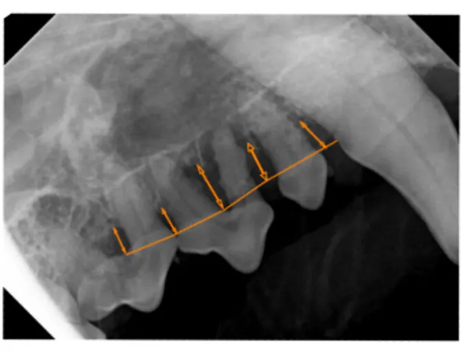 Grade 4 bone loss upper radiograph Grade 4 bone loss upper radiograph