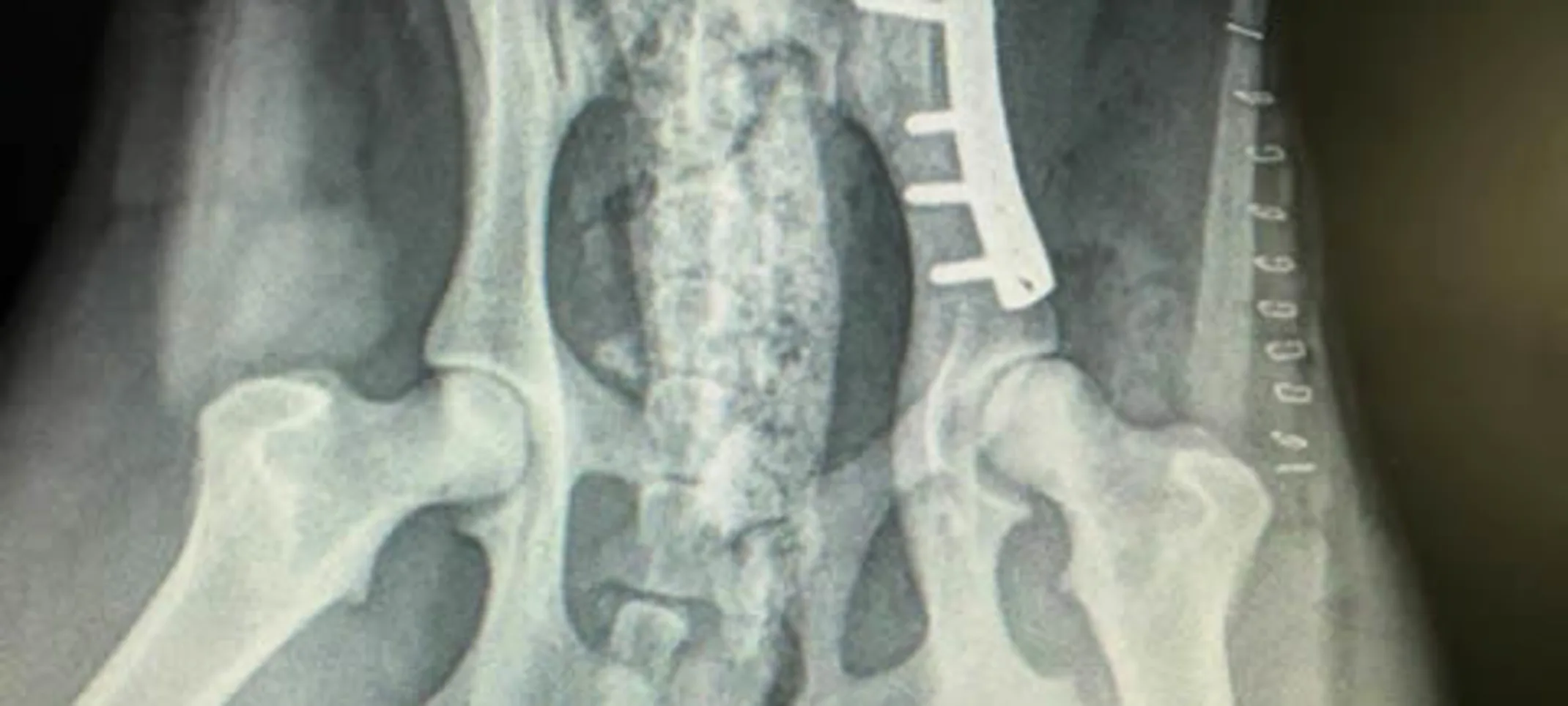 Image of hip surgery Image of hip surgery