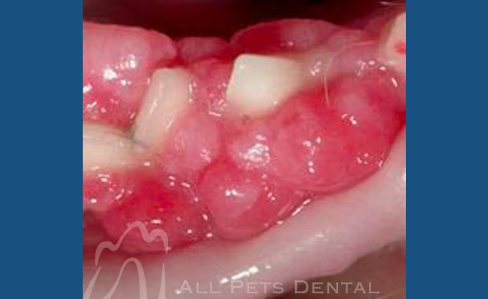 Peripheral Odontogenic Fibroma Peripheral Odontogenic Fibroma