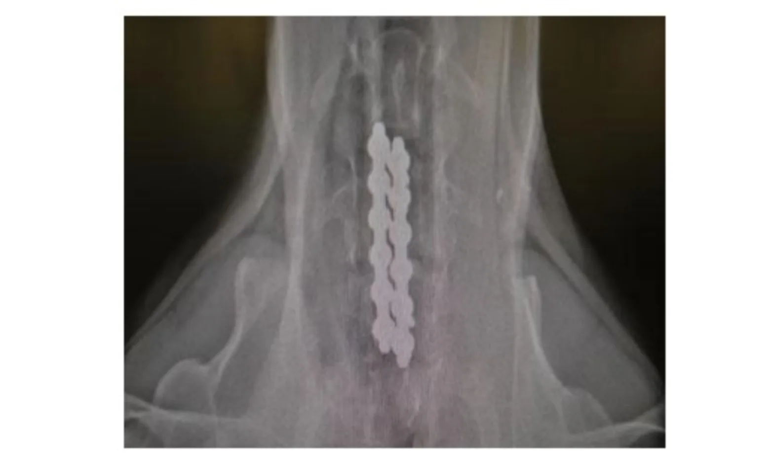PMMA (bone cement) is placed so that it spans the two vertebrae and screw heads PMMA (bone cement) is placed so that it spans the two vertebrae and screw heads