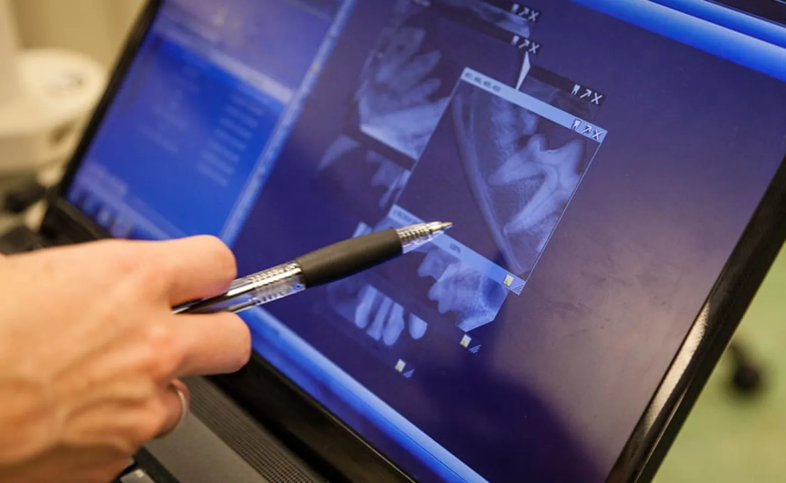 HAND WITH PEN POINTING AT XRAY HAND WITH PEN POINTING AT XRAY