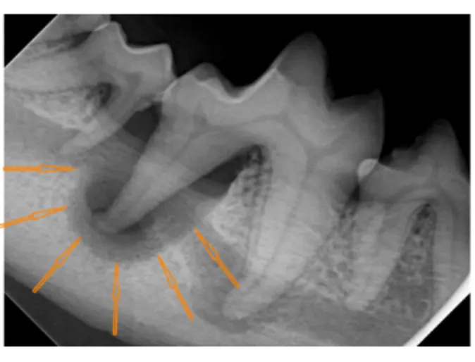 Grade 3 tooth root abscess Grade 3 tooth root abscess