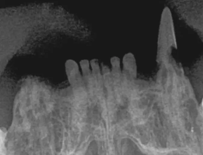 Resorptive lesions affecting roots and crowns   Resorptive lesions affecting roots and crowns