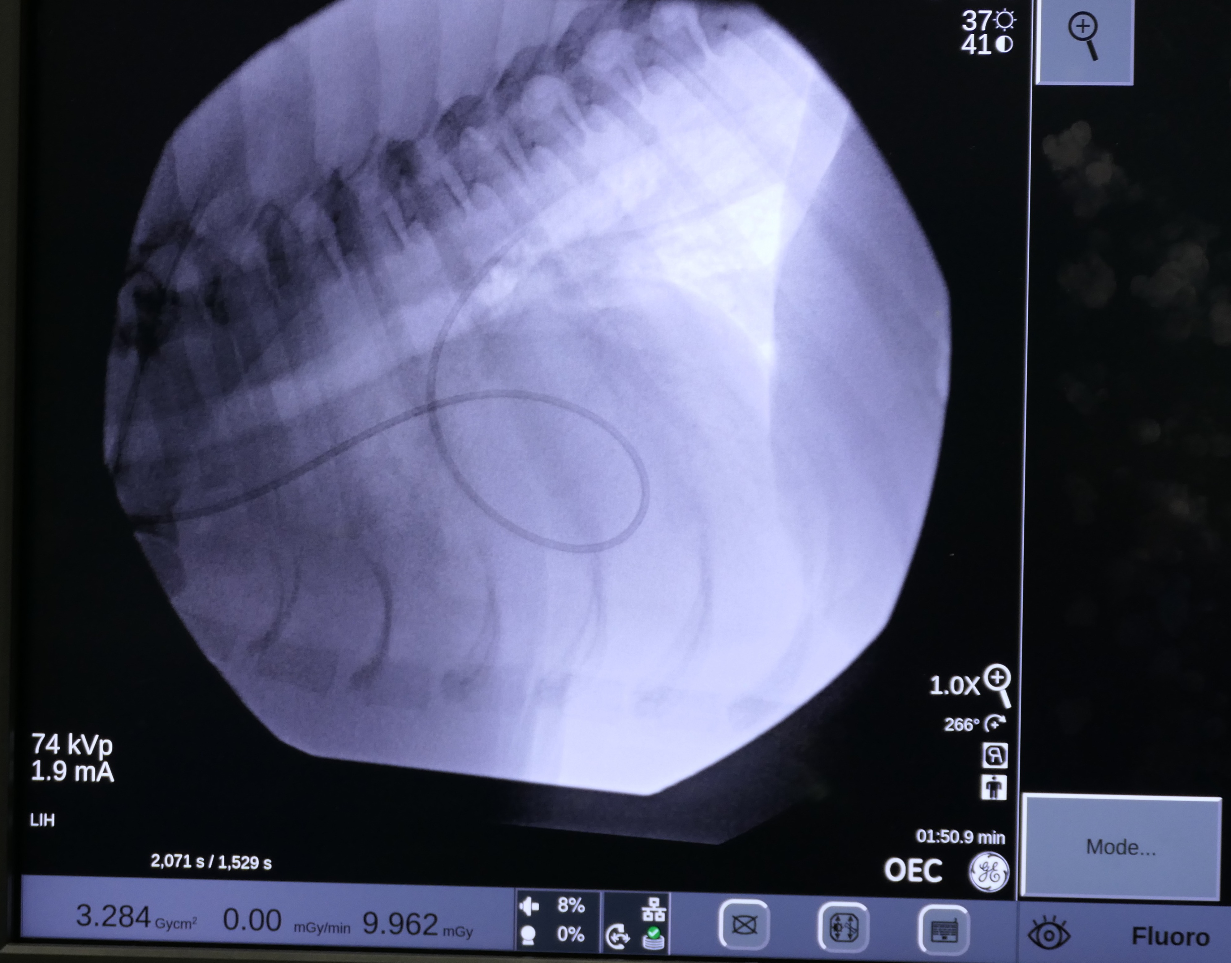 An x-ray of balloon valvuloplasty. 