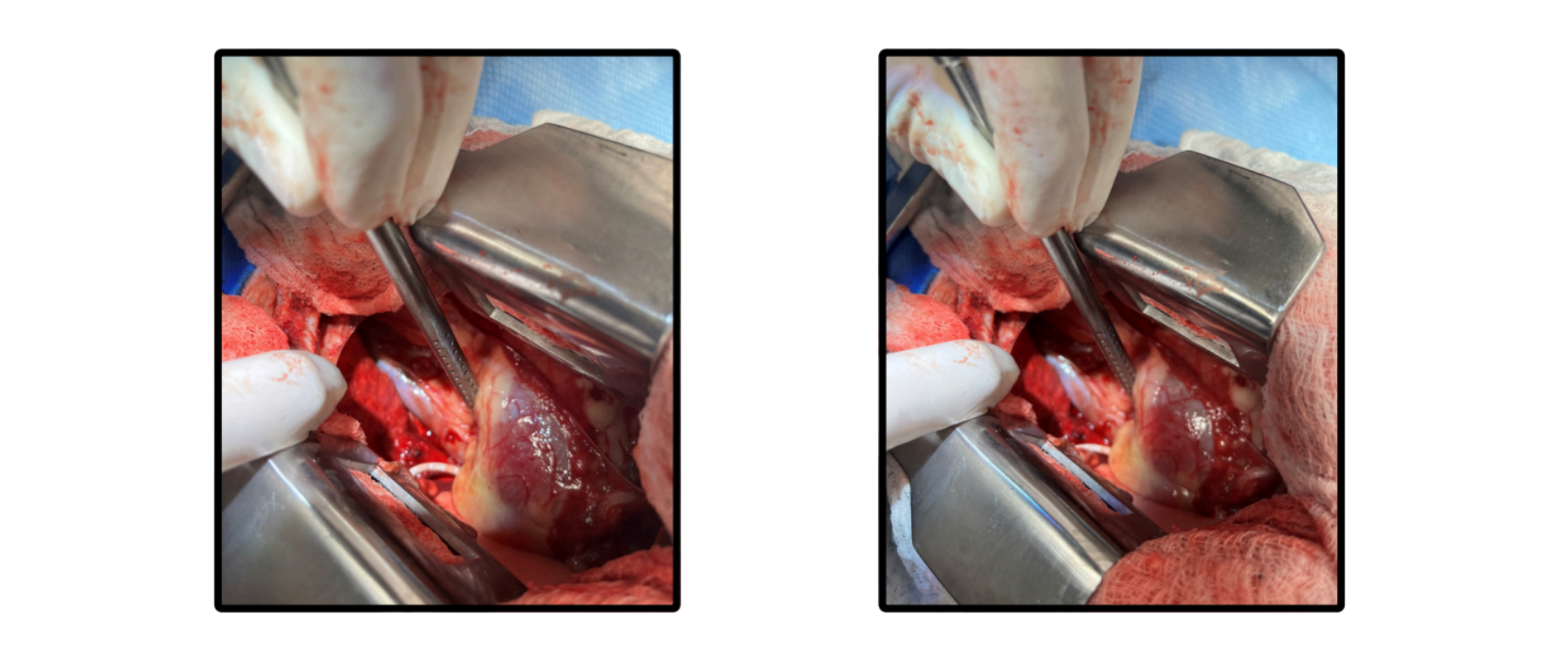 Surgical Intervention