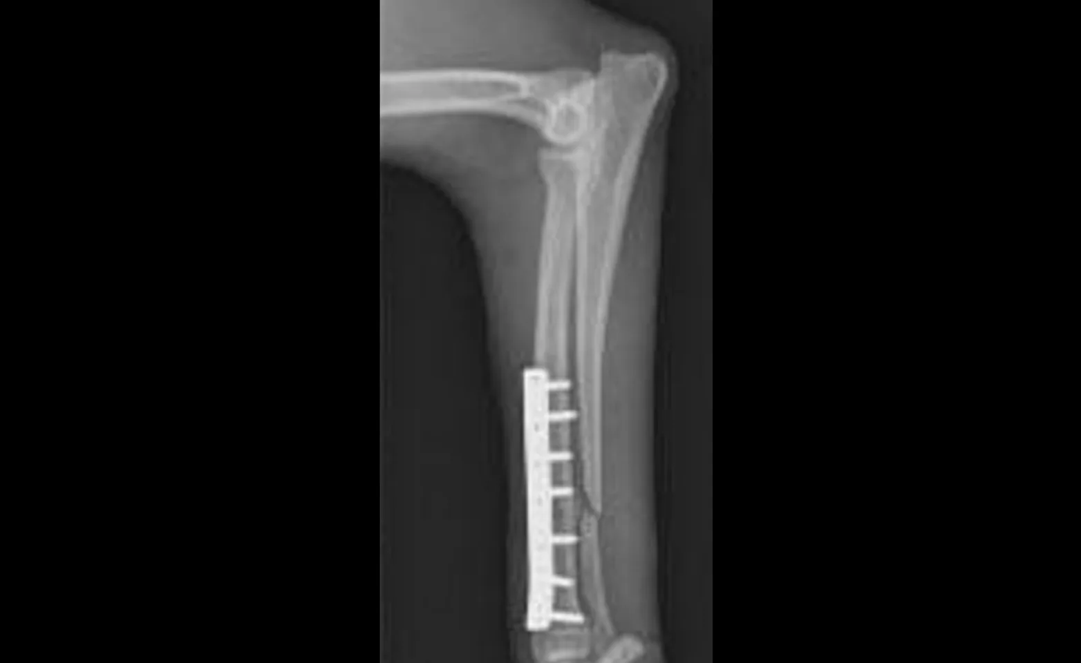 Fracture being stabilized Fracture being stabilized