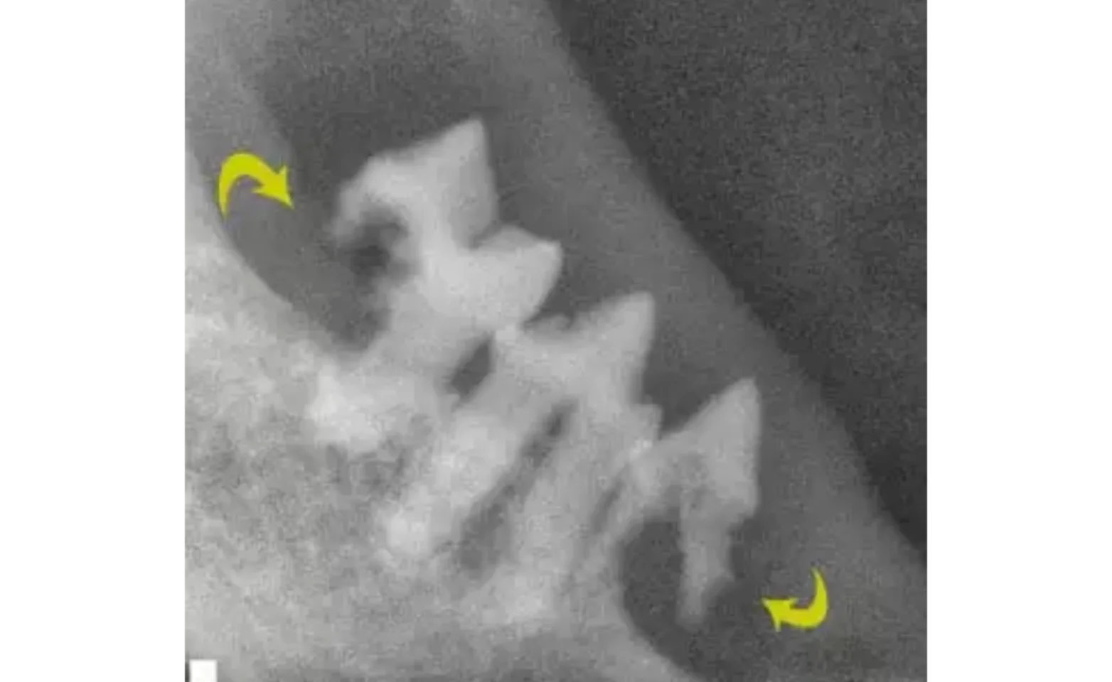 Teeth X-Ray Teeth X-Ray