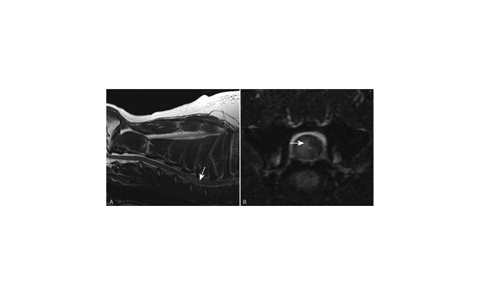 MRI images showing a hyperintense region consistent with FCE. MRI images showing a hyperintense region consistent with FCE.