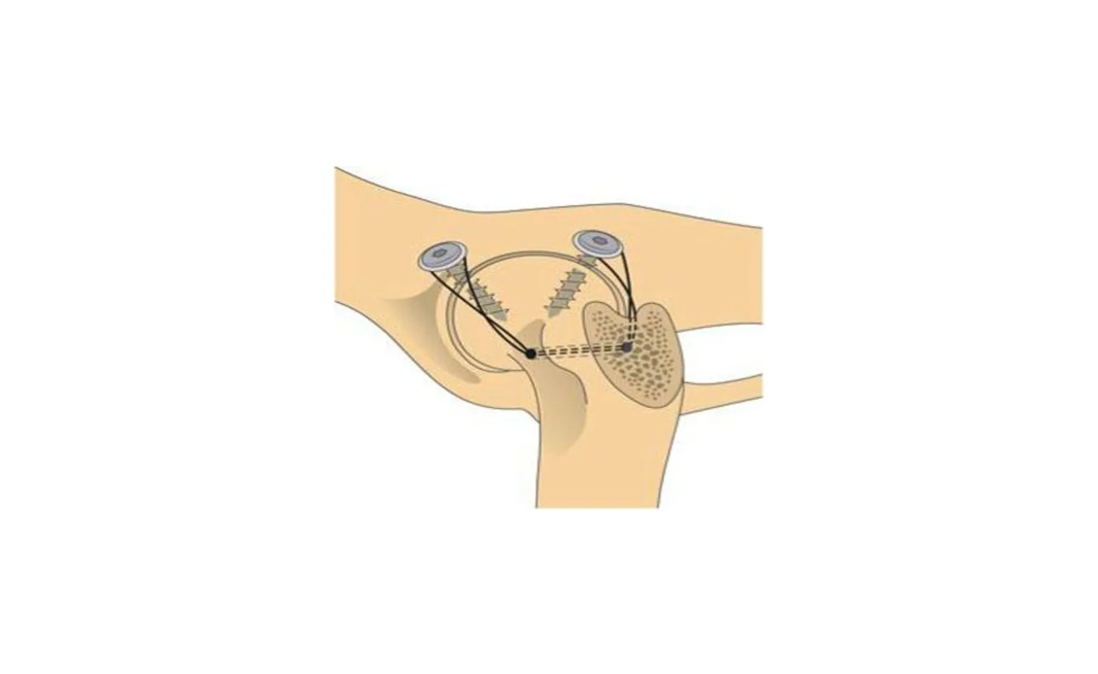 Prosthetic Capsule diagram image of screw placements Prosthetic Capsule diagram image of screw placements