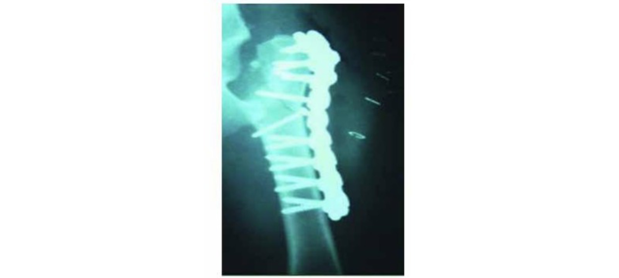 Locking plate technology and biological fixation techniques