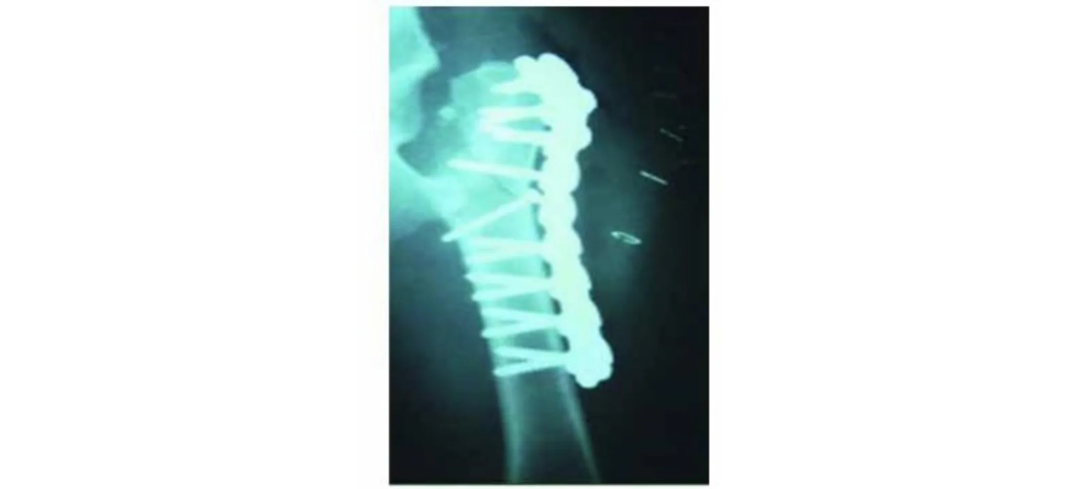 Locking plate technology and biological fixation techniques Locking plate technology and biological fixation techniques