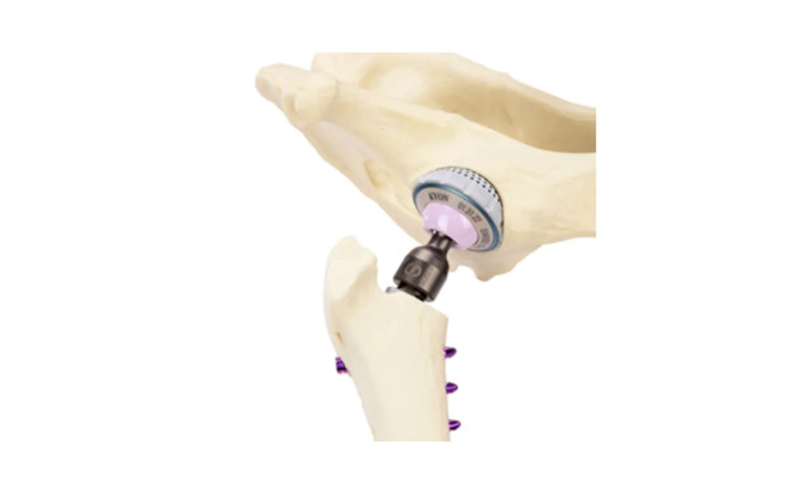 Figure or Total Hip Replacement Figure or Total Hip Replacement