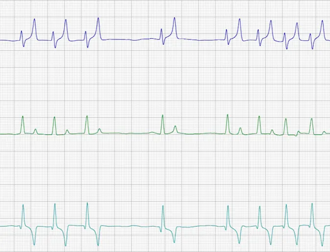 Echocardiogram Echocardiogram