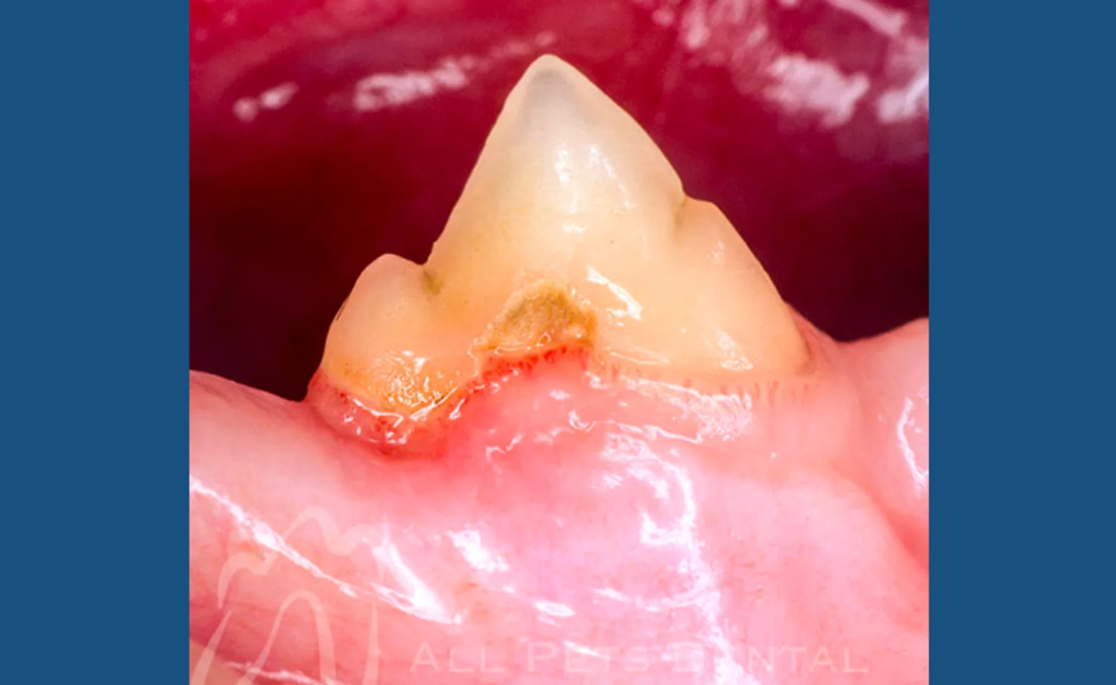 Stage 2 Tooth Resorption