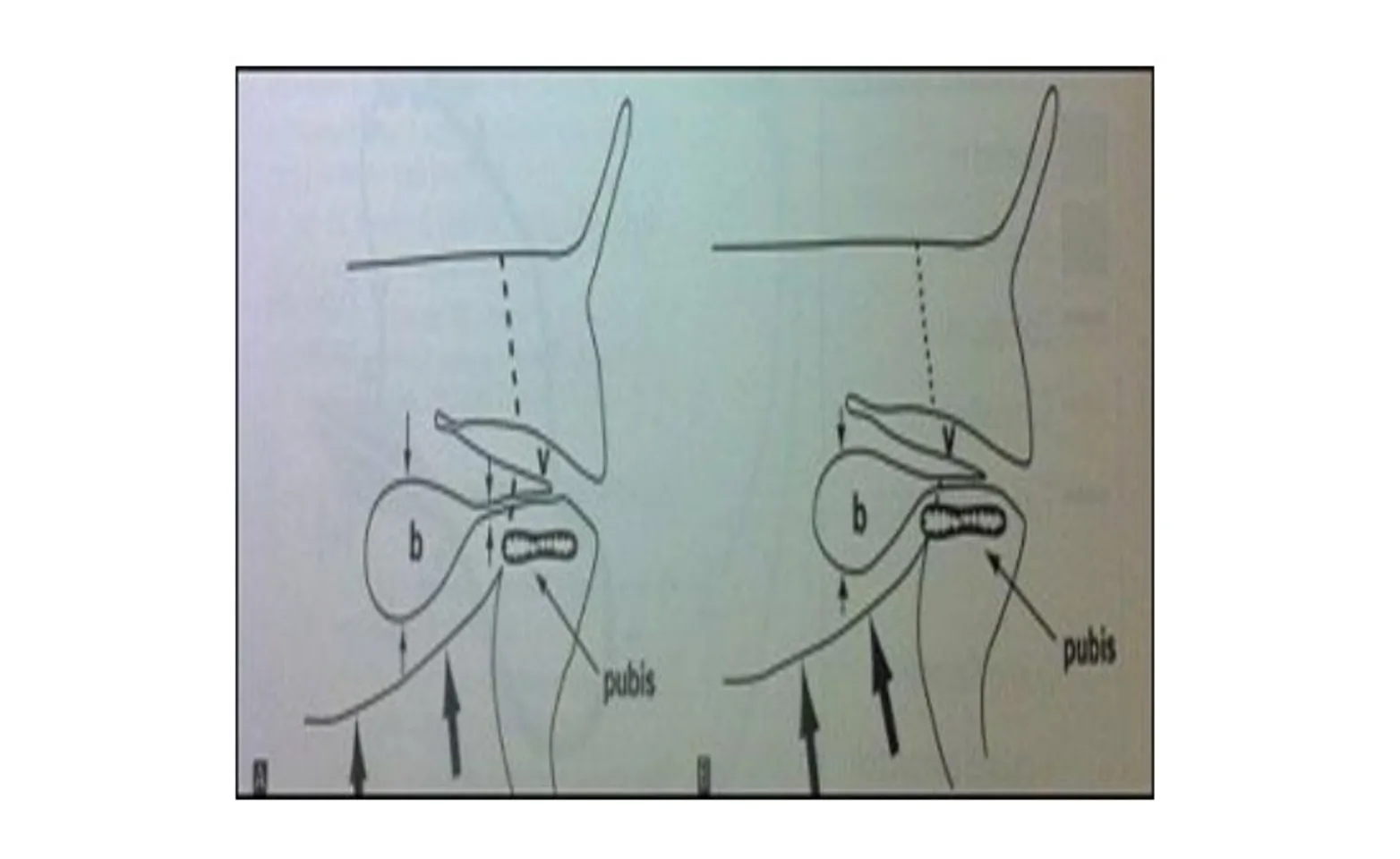 Illustration of normal intraabdominal bladder position (left) and pelvic bladder (right). Illustration of normal intraabdominal bladder position (left) and pelvic bladder (right).