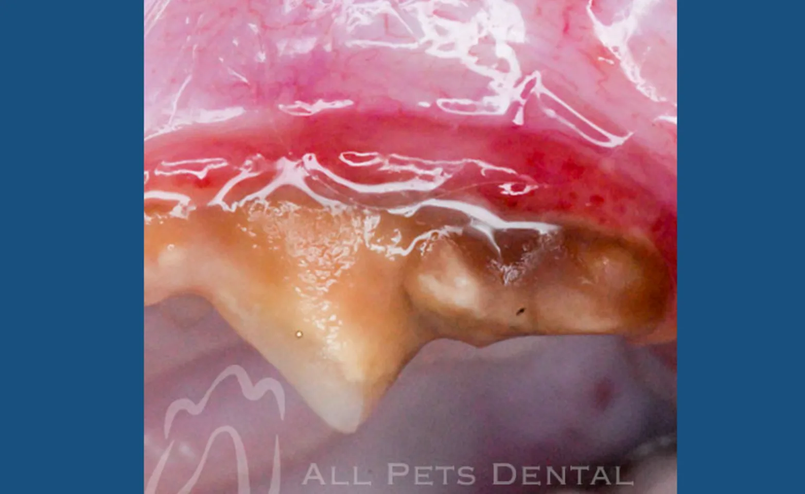 Periodontal Stage 2 Periodontal Stage 2
