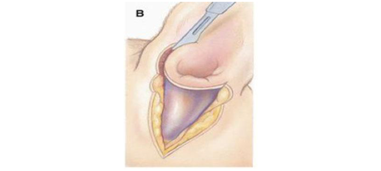 Sharp dissection is used to incise around the external opening of the ear canal and separate it from the base of the pinna.