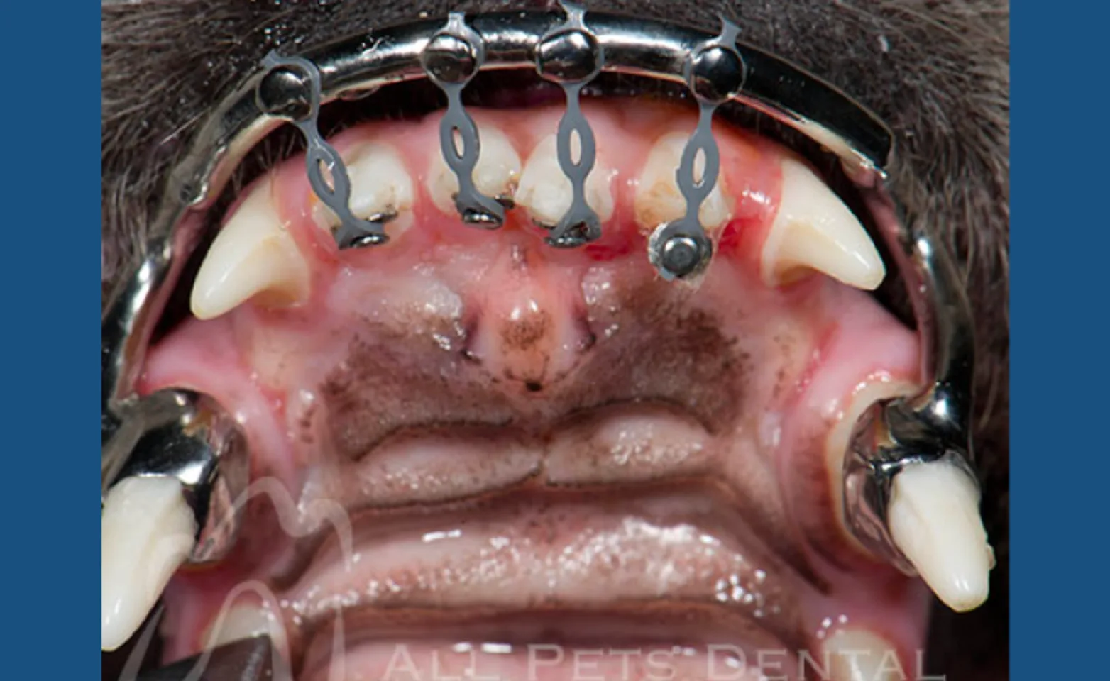 Arch Bar and Elastic Orthodontic Appliance Arch Bar and Elastic Orthodontic Appliance