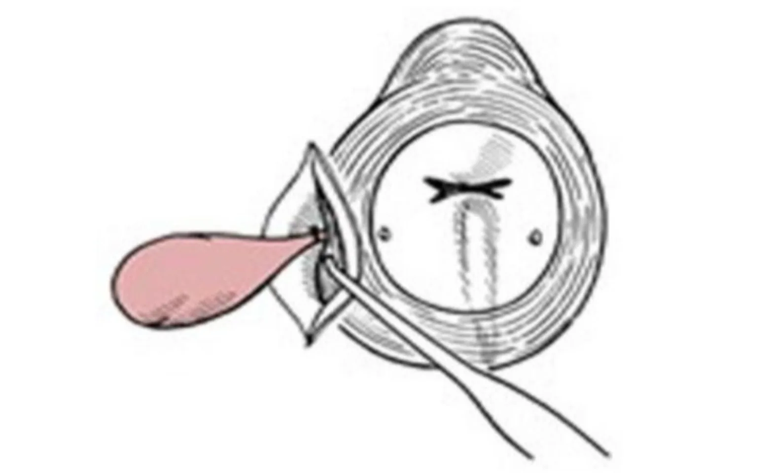 The anal sac has been dissected free and the duct is tied off with suture. The anal sac has been dissected free and the duct is tied off with suture.