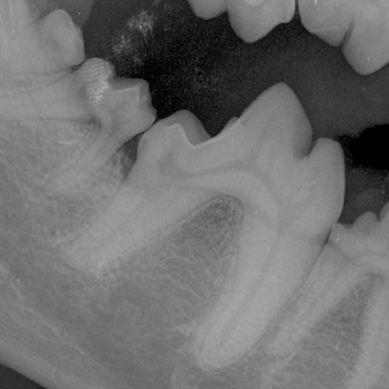 Dental Radiograph