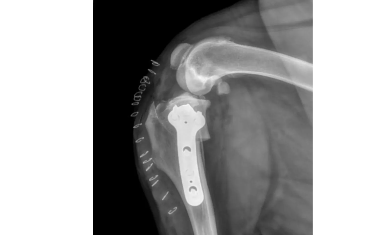 TPLO X-Ray TPLO X-Ray