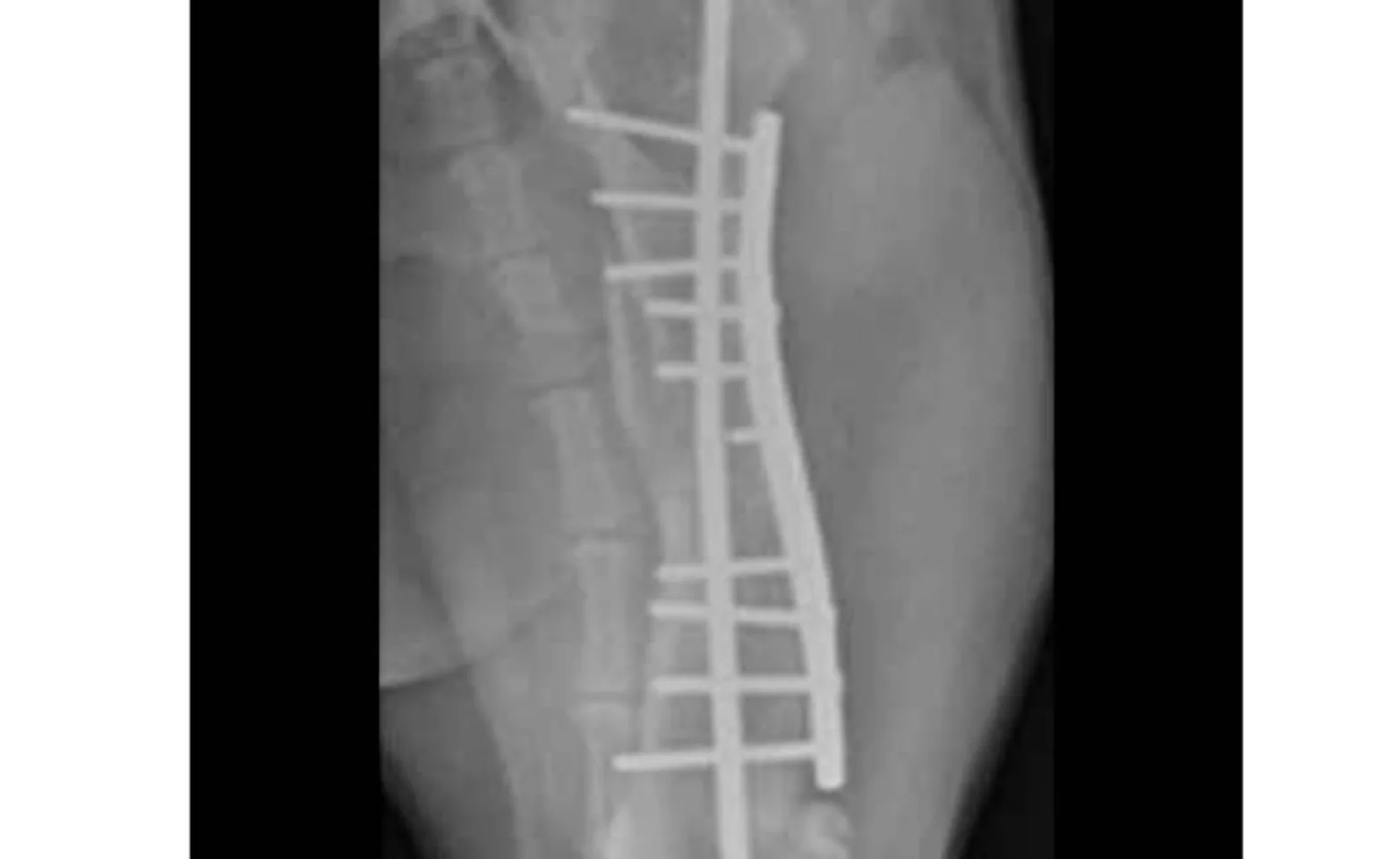 Image of a fractured bone Image of a fractured bone