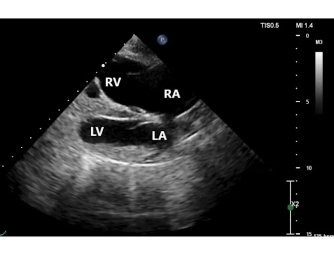Radiograph: with sections RA=right atrium; RV=right ventricle; LA= left atrium; LV=left ventricle Radiograph: with sections RA=right atrium; RV=right ventricle; LA= left atrium; LV=left ventricle
