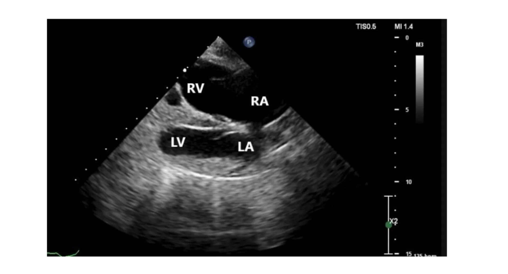 Radiograph: with sections RA=right atrium; RV=right ventricle; LA= left atrium; LV=left ventricle Radiograph: with sections RA=right atrium; RV=right ventricle; LA= left atrium; LV=left ventricle