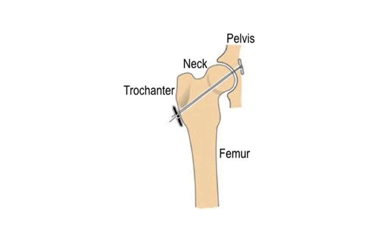 Diagram image of a Toggle-Rod Fixation Diagram image of a Toggle-Rod Fixation