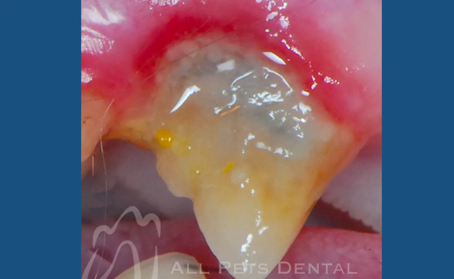 Periodontal Stage 4 Periodontal Stage 4