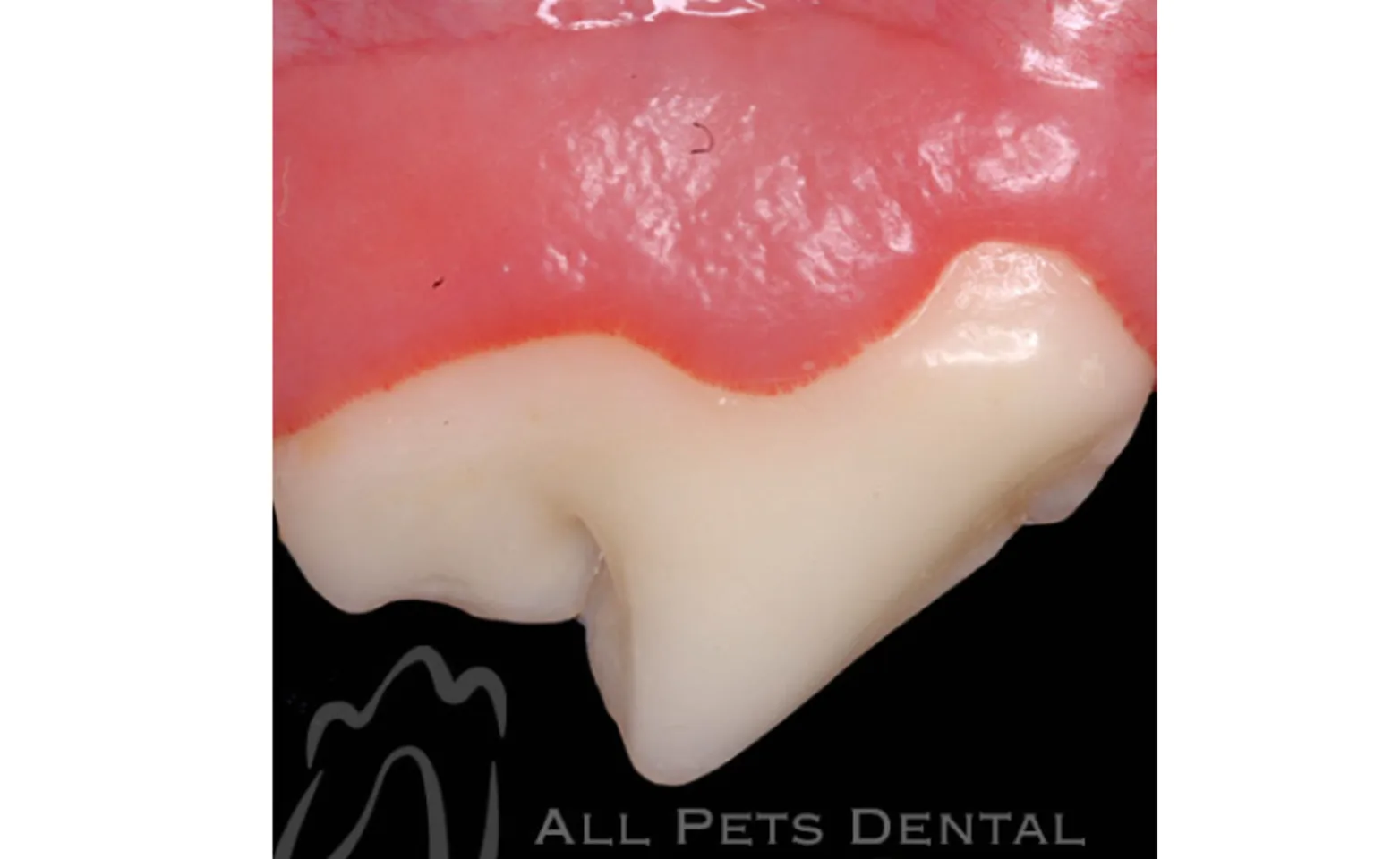 Example of Gingival Recession Example of Gingival Recession