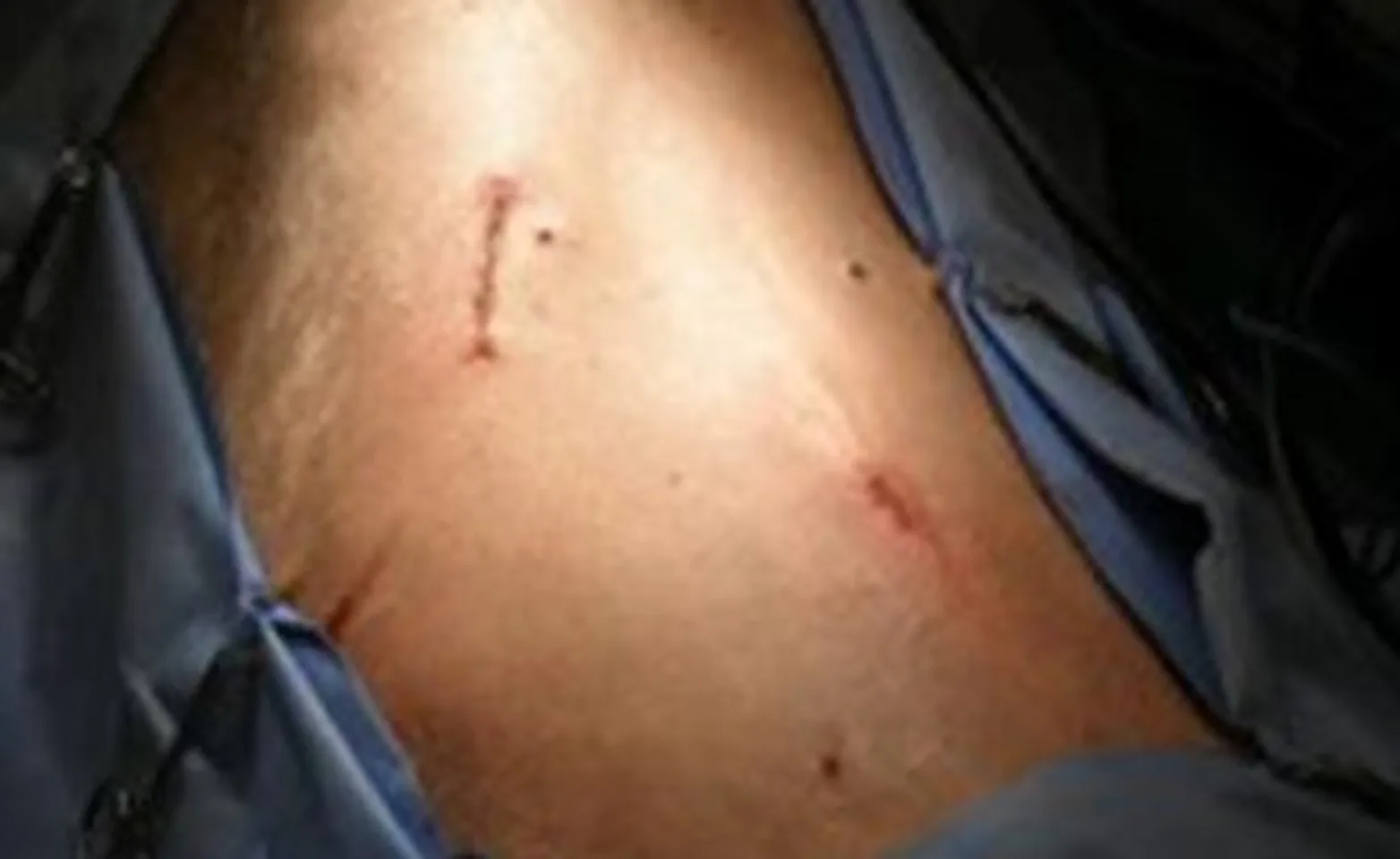 two small incisions from a completed laparoscopic gastropexy two small incisions from a completed laparoscopic gastropexy