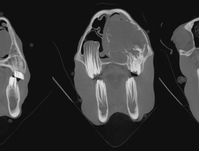Aneurysmal Bone Cyst Aneurysmal Bone Cyst