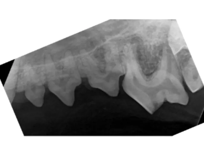 Grade 1 upper radiography Grade 1 upper radiography