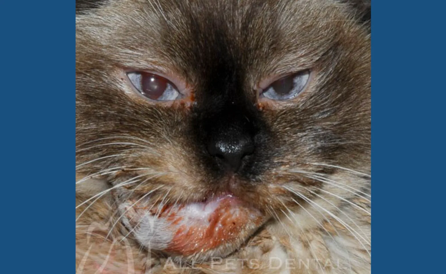 Squamous Cell Carcinoma Squamous Cell Carcinoma