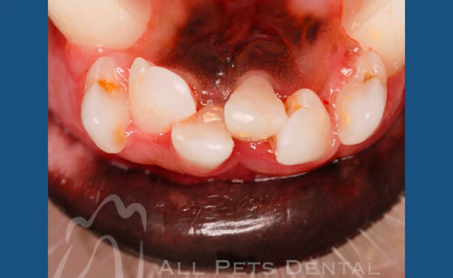 Crowded Teeth Crowded Teeth