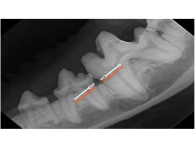 Grade 2 bone loss with arrows Grade 2 bone loss with arrows