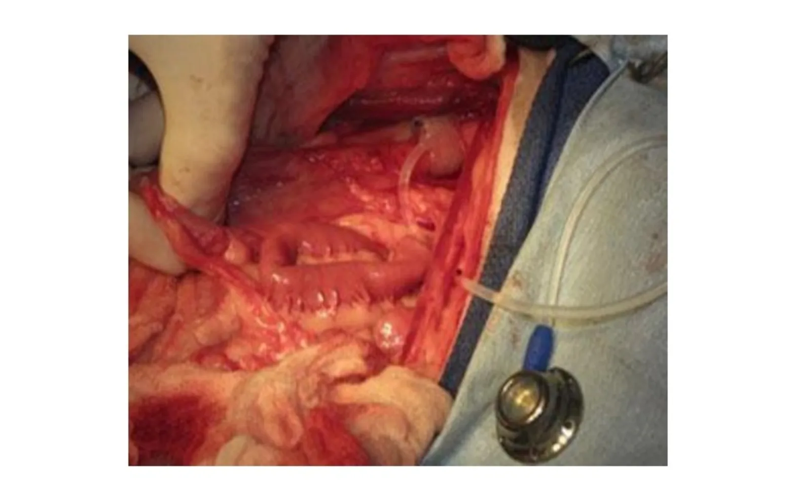 Artifcial sphincter in place. Courtesy Dr. James Flanders, Cornell University. Artifcial sphincter in place. Courtesy Dr. James Flanders, Cornell University.