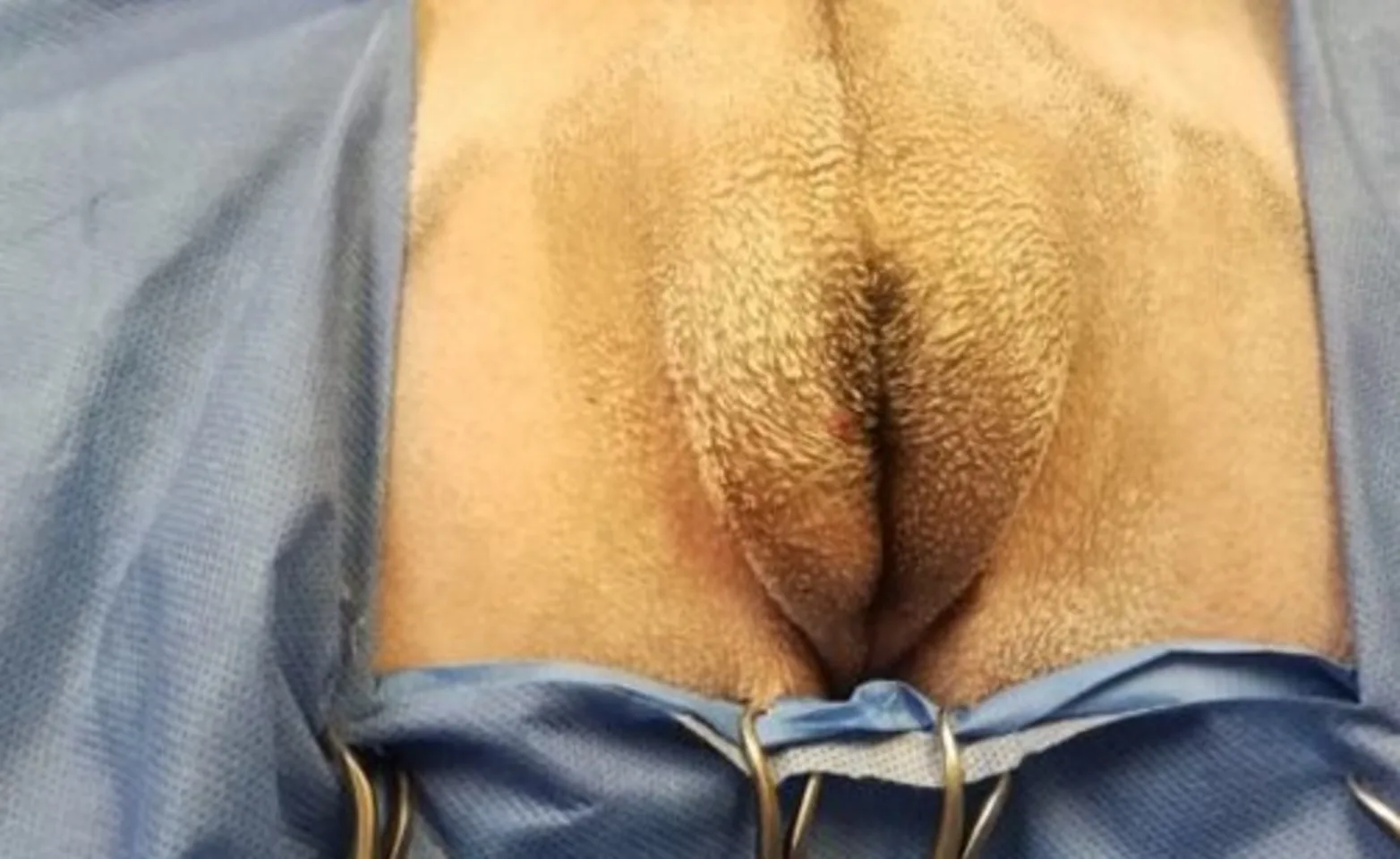 excessive skin area excessive skin area