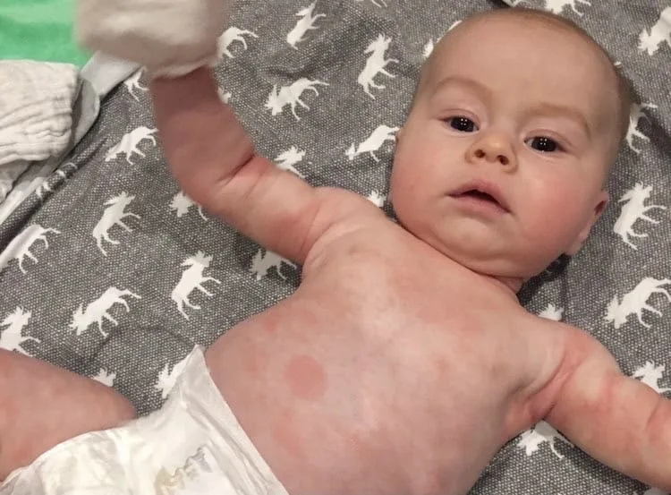 a baby with a full body rash in an allergic reaction