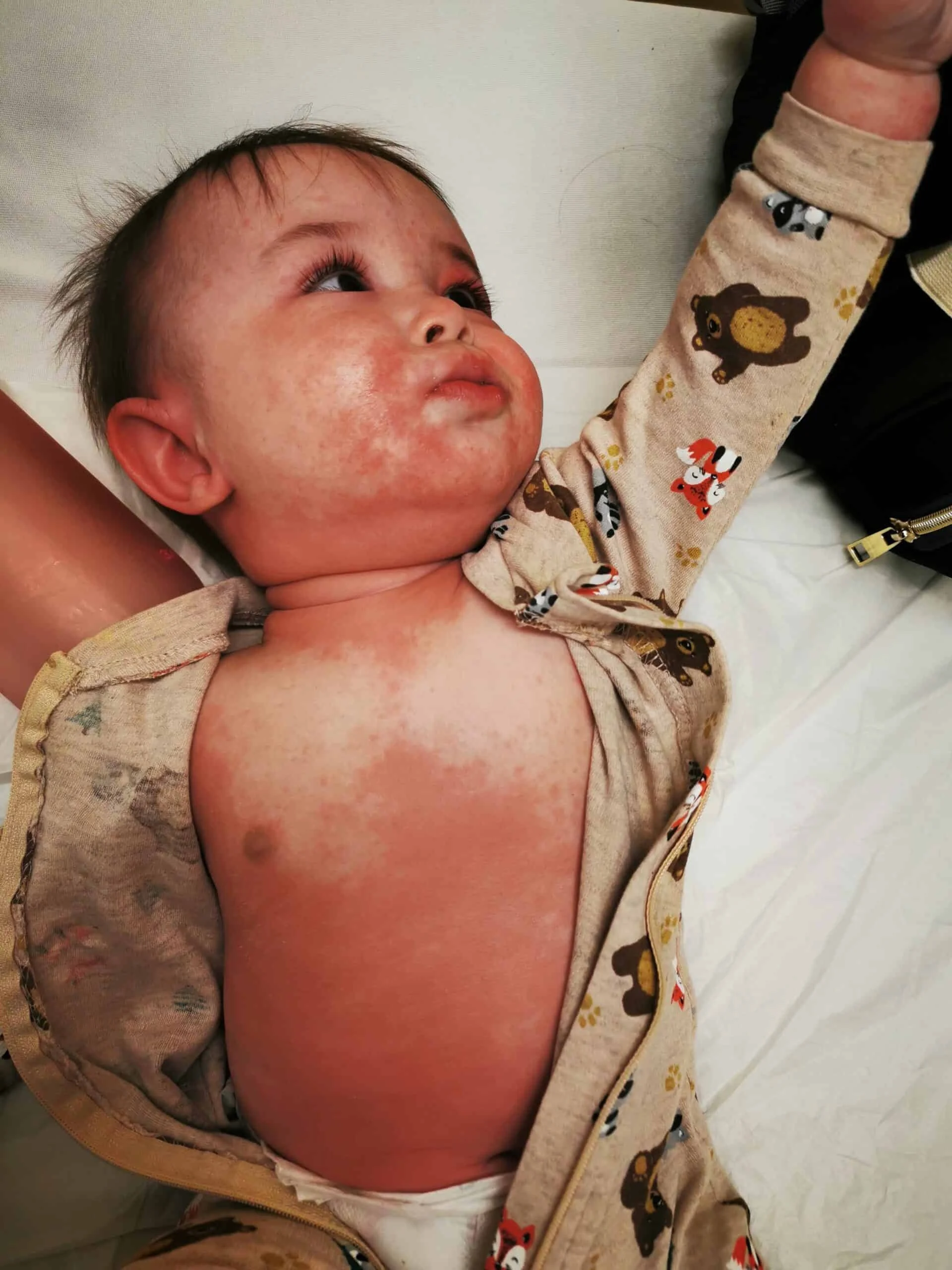 a 9 month old with widespread rash in an allergic reaction