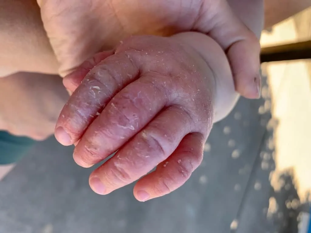 A baby’s hand with red, dry, cracked skin across the fingers and knuckles.
