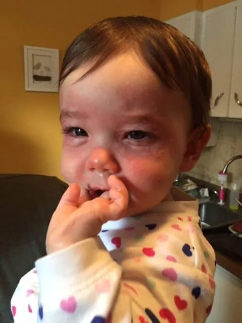 a 10 month old with facial swelling and rash from allergic reaction to cashews