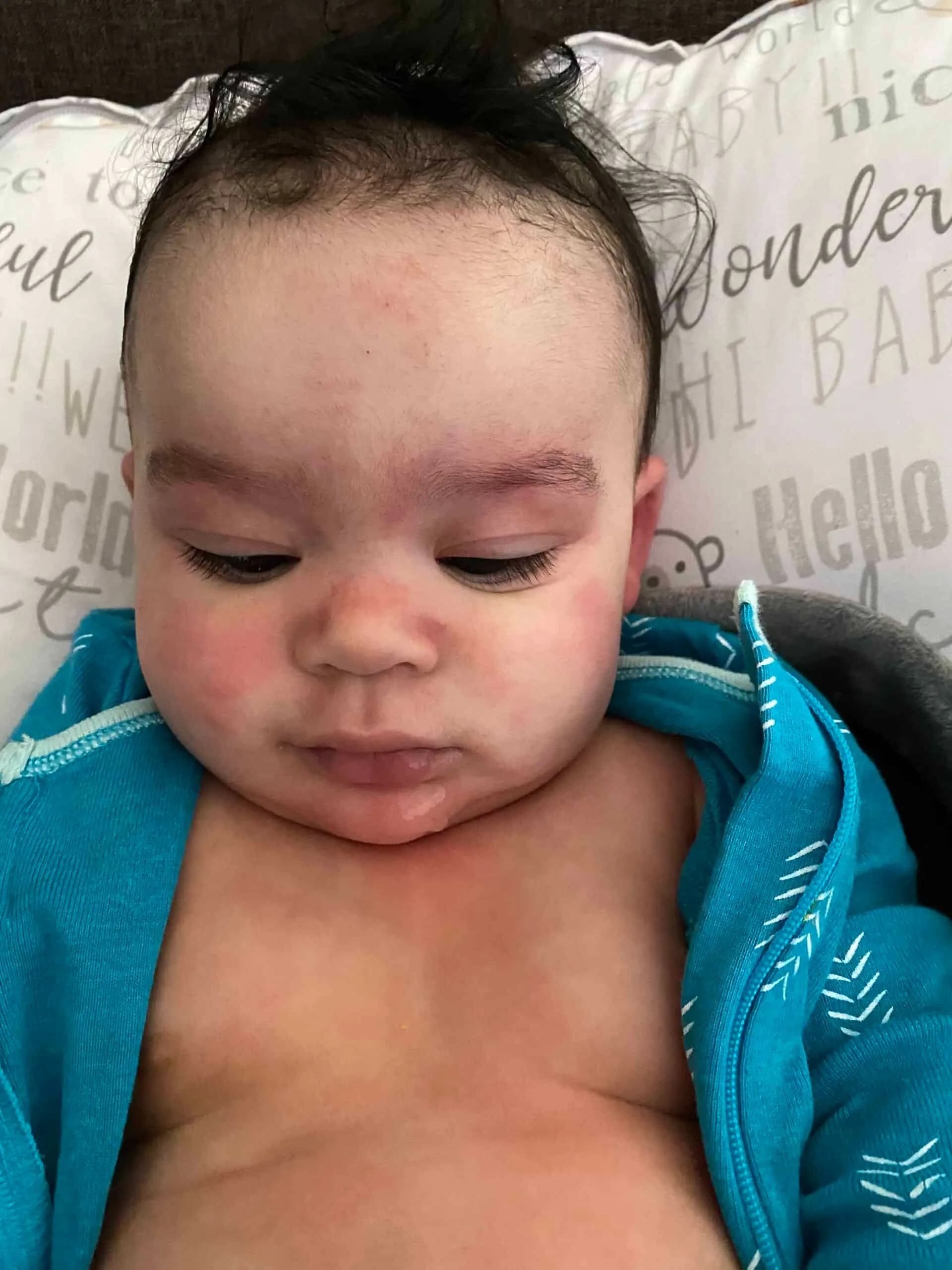 Face chest rash