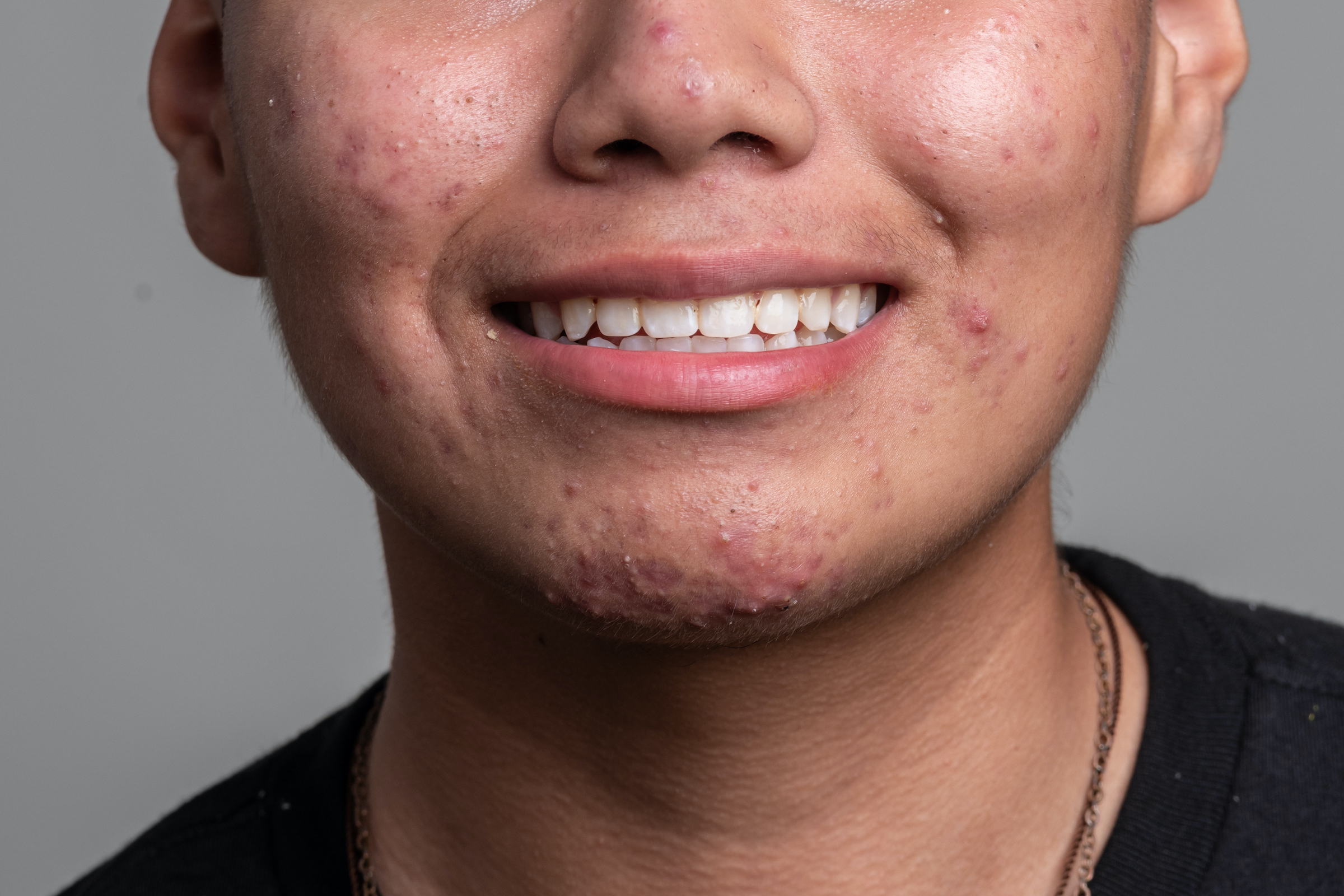 acne dating site girlfriend cum face