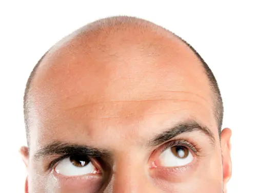 The Real Reasons Men Go Bald & What You Can Do About It-1