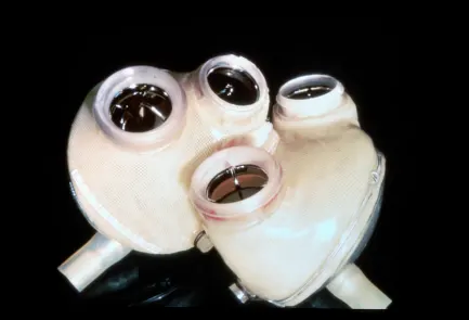 What We Know 30 Years Since the First Artificial Heart-3